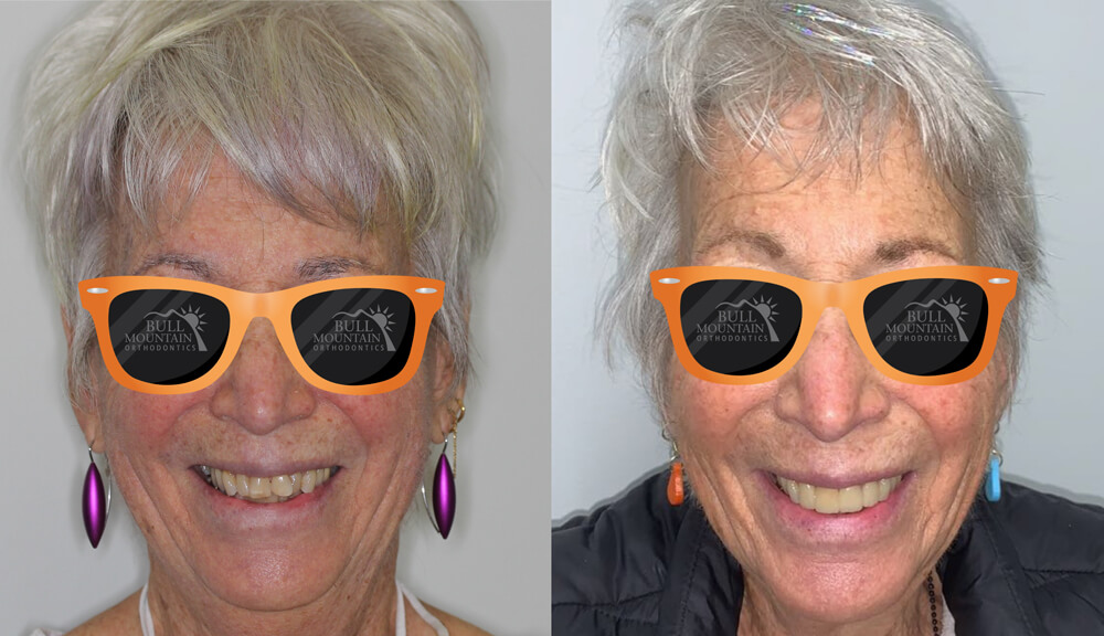 Before-and-after images of a smiling woman showcasing orthodontic transformation, featuring Bull Mountain Orthodontics sunglasses, emphasizing the effectiveness of treatments like braces and Invisalign in Tigard.