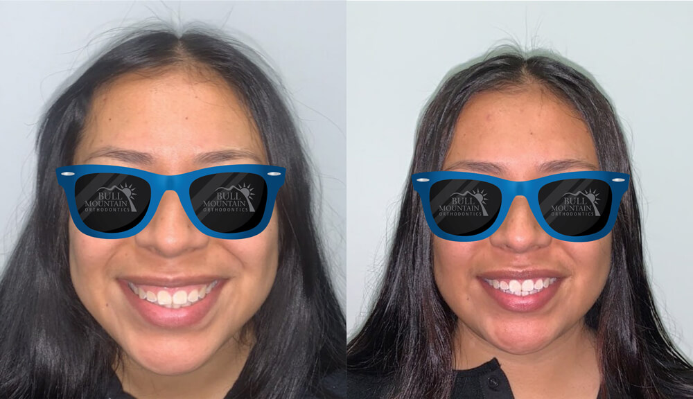 Before-and-after smile transformation featuring a patient with braces, showcasing improved alignment and confidence, branded with Bull Mountain Orthodontics logo.