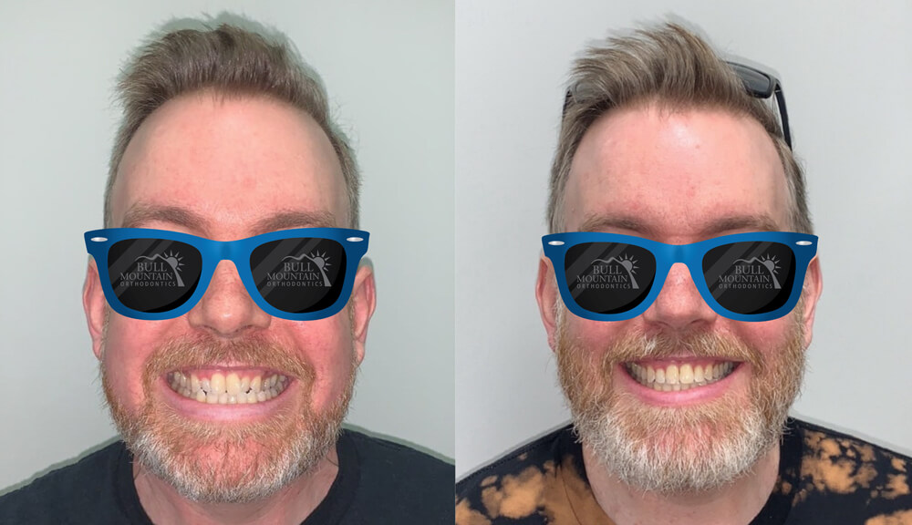 Man smiling with braces on the left and a transformed smile after treatment on the right, both wearing blue sunglasses with the Bull Mountain Orthodontics logo, showcasing orthodontic results in Tigard.