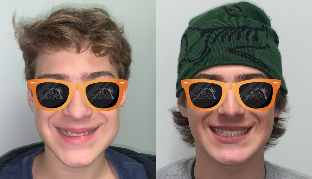 Before-and-after images of a young male patient showcasing orthodontic transformation with braces, wearing sunglasses branded with Bull Mountain Orthodontics logo, illustrating effective orthodontic treatment results in Tigard.