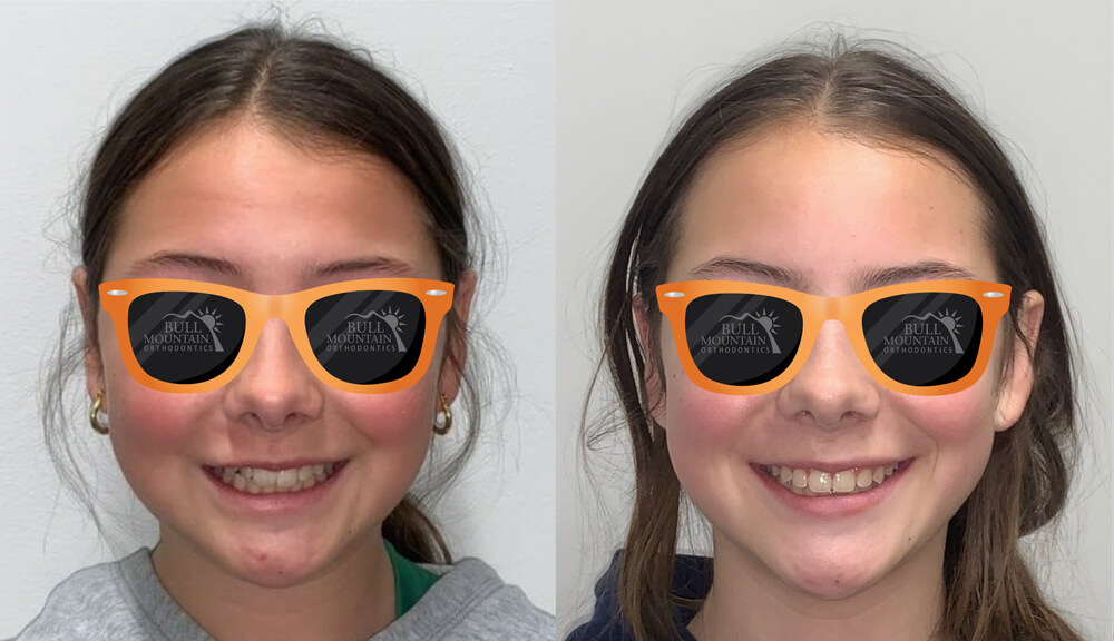 Before-and-after image of a young girl showcasing orthodontic transformation, wearing branded sunglasses from Bull Mountain Orthodontics, highlighting effective braces and Invisalign treatments in Tigard.