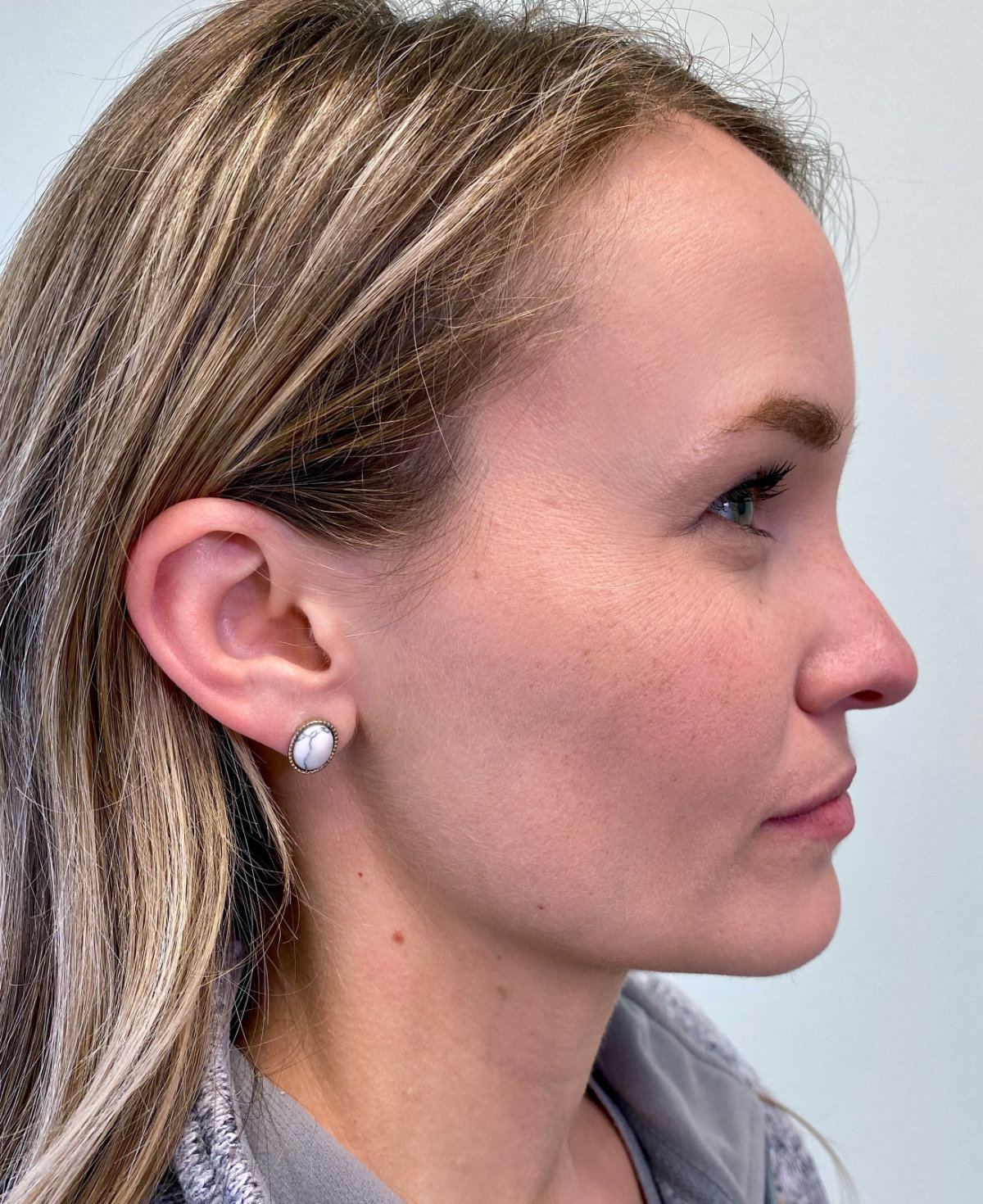 Patient profile showcasing orthodontic assessment for Invisalign in Tigard, by an orthodontist at Bull Mountain Orthodontics.