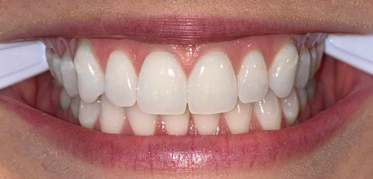 Close-up of healthy, straight teeth illustrating Invisalign and orthodontic treatment options from an orthodontist in Tigard.