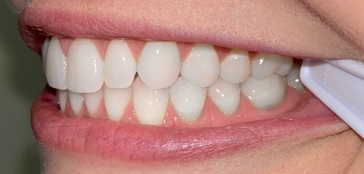 Close-up of healthy teeth and gums for virtual orthodontic consultation in Tigard.
