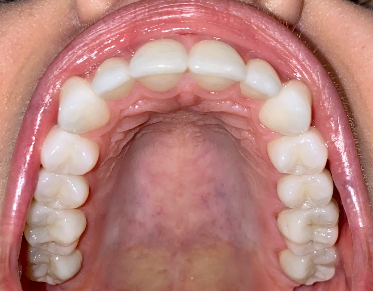 Close-up view of teeth for virtual orthodontic assessment by an orthodontist in Tigard, potentially needing braces or Invisalign.