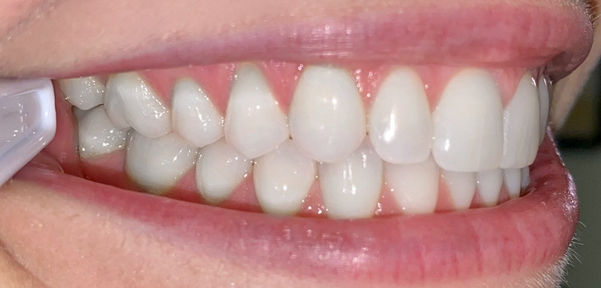 Close-up of teeth for virtual orthodontic consultation at Bull Mountain Orthodontics, Tigard orthodontics offering braces and Invisalign.