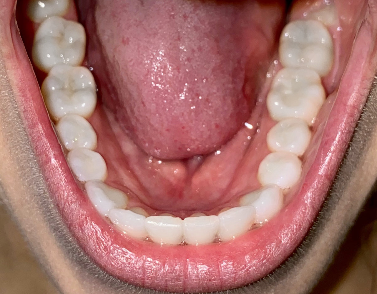 Close-up view of teeth for virtual orthodontic consultation, potential Invisalign or braces treatment in Tigard.