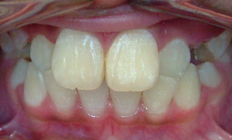 Before and after orthodontic treatment showcasing improved smile with braces or Invisalign at Bull Mountain Orthodontics, an orthodontist in Tigard.