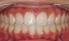 Before and after dental transformation showcasing orthodontic results by an orthodontist in Tigard, potentially with braces or Invisalign.